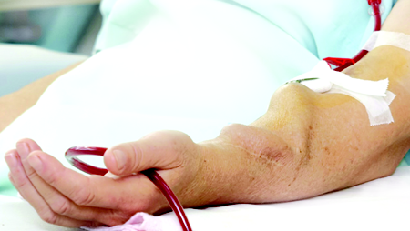 A_Vascular_Access_Fistula.png
