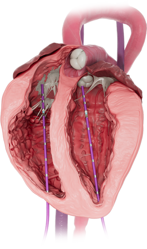 Biventricular-img-1