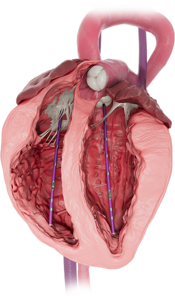 Biventricular-img-2