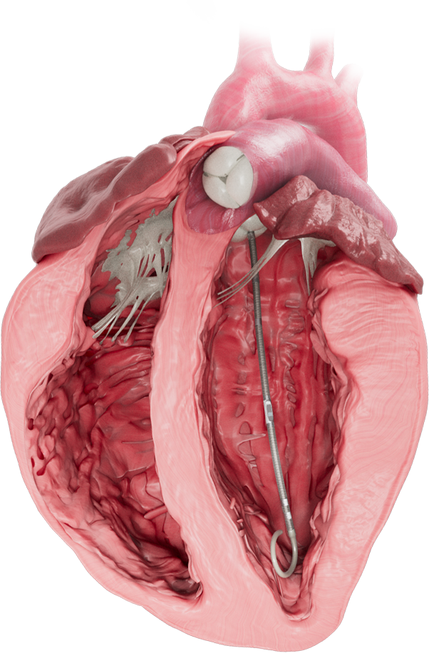 Left-Ventricle-img-2