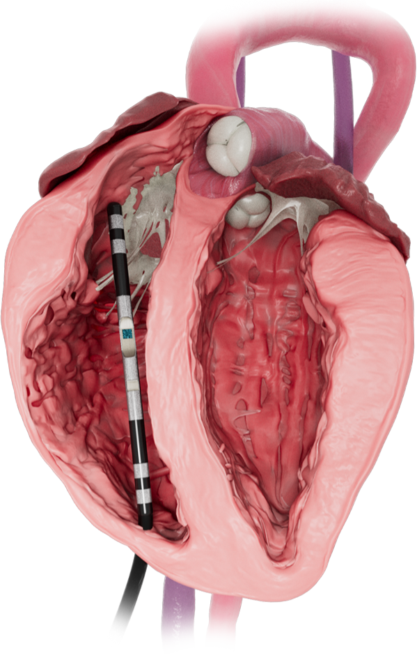 right-Ventricle-img-1