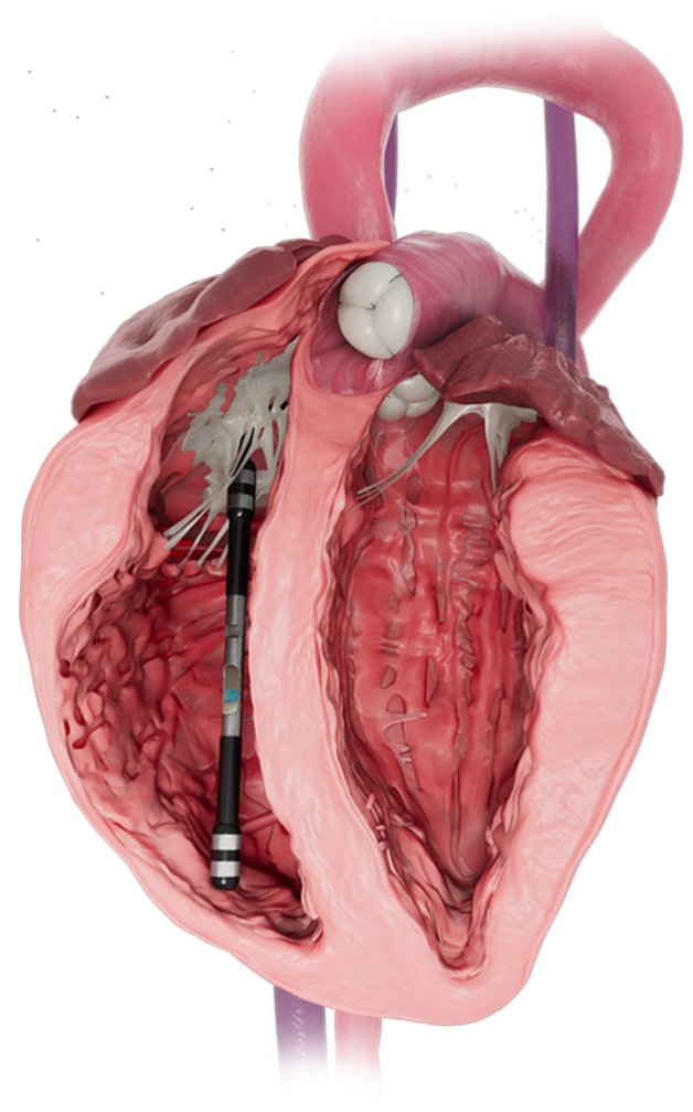 right-Ventricle-img-2