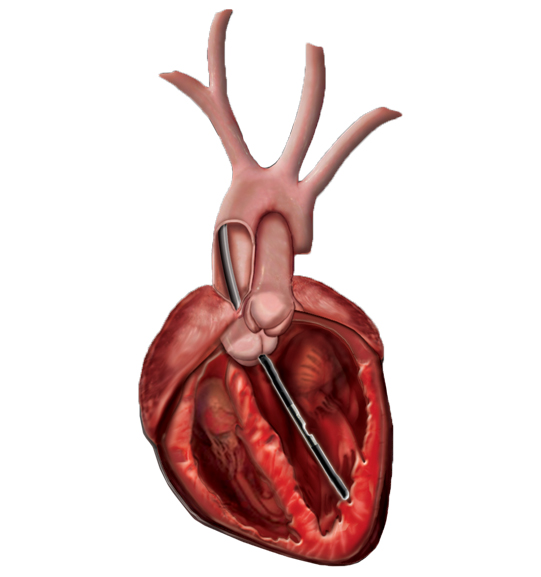 Product_Rodent-Catheter1